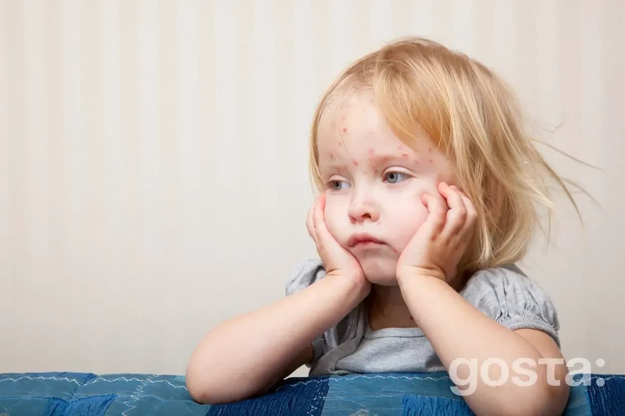 How chickenpox spreads