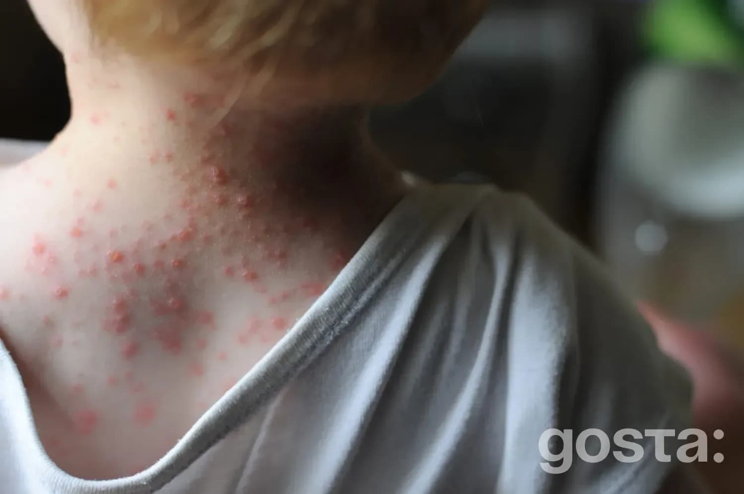 Ways chickenpox spreads