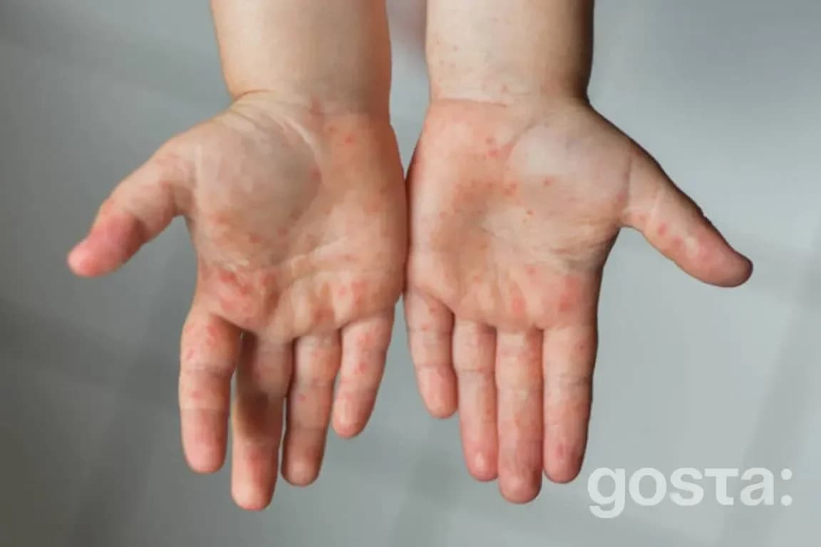 Enterovirus infection prevention