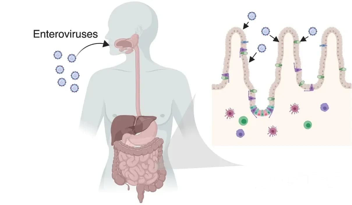Enterovirus infection symptoms
