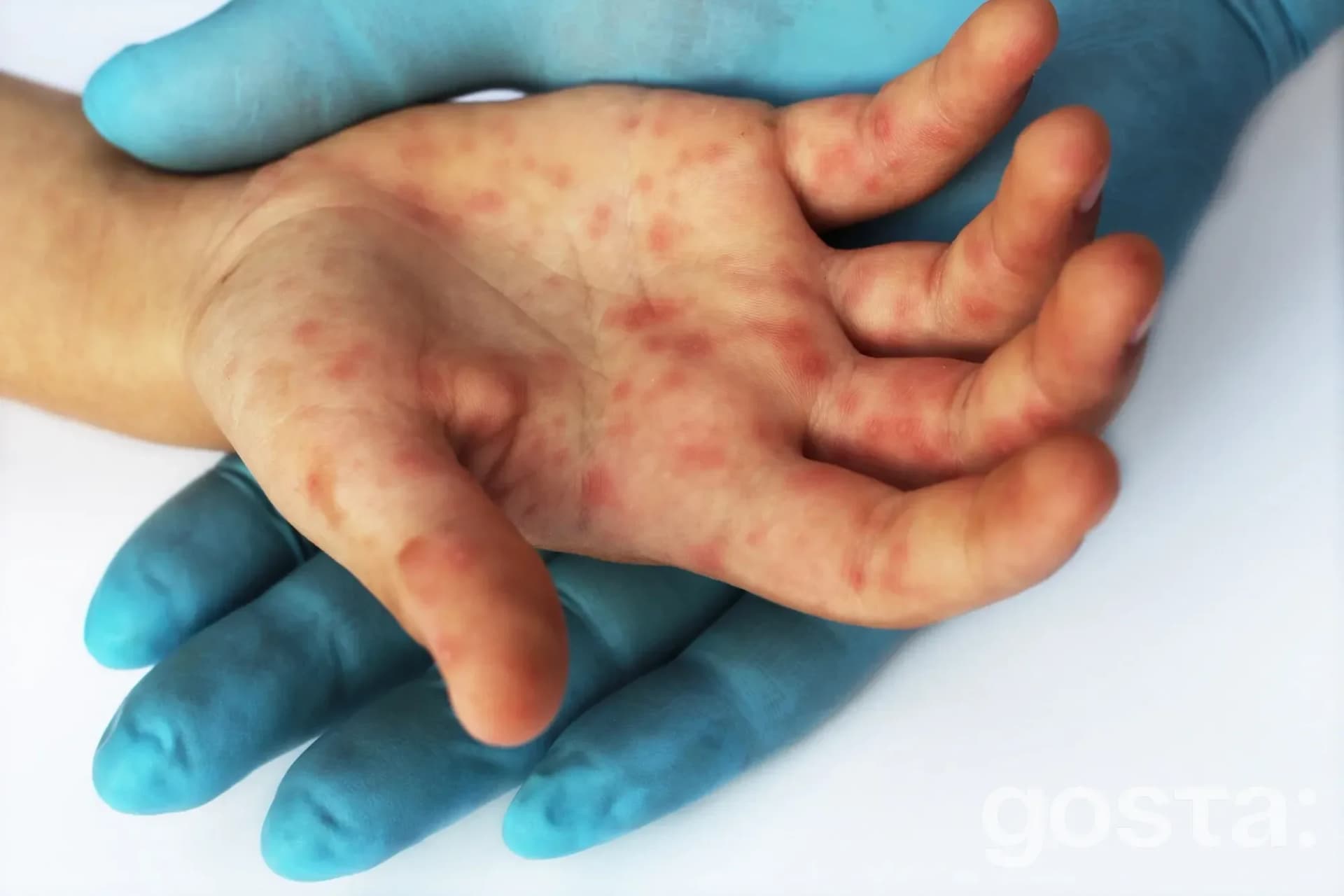 Enterovirus infection treatment