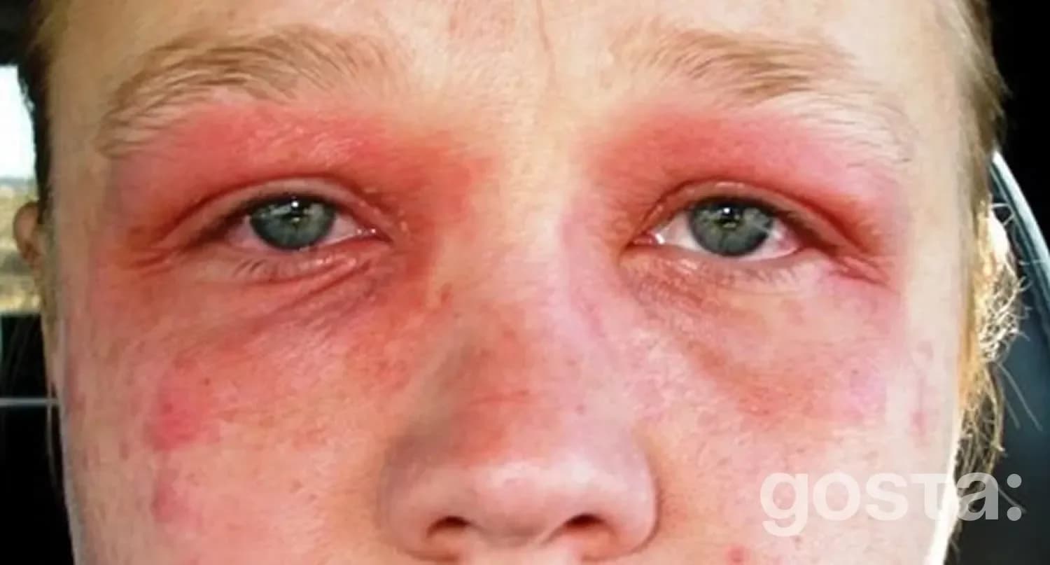 Symptoms of seasonal allergy