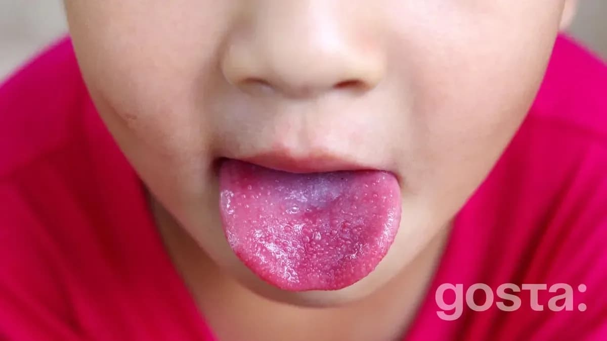 Scarlet Fever Rash