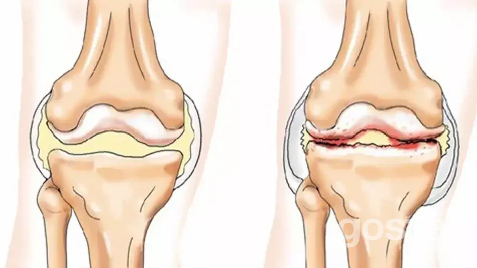 Артроз: профілактика – ваш кращий захист