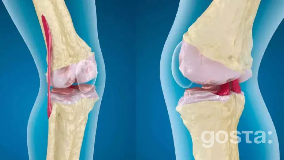 Артроз: як полегшити біль та покращити життя