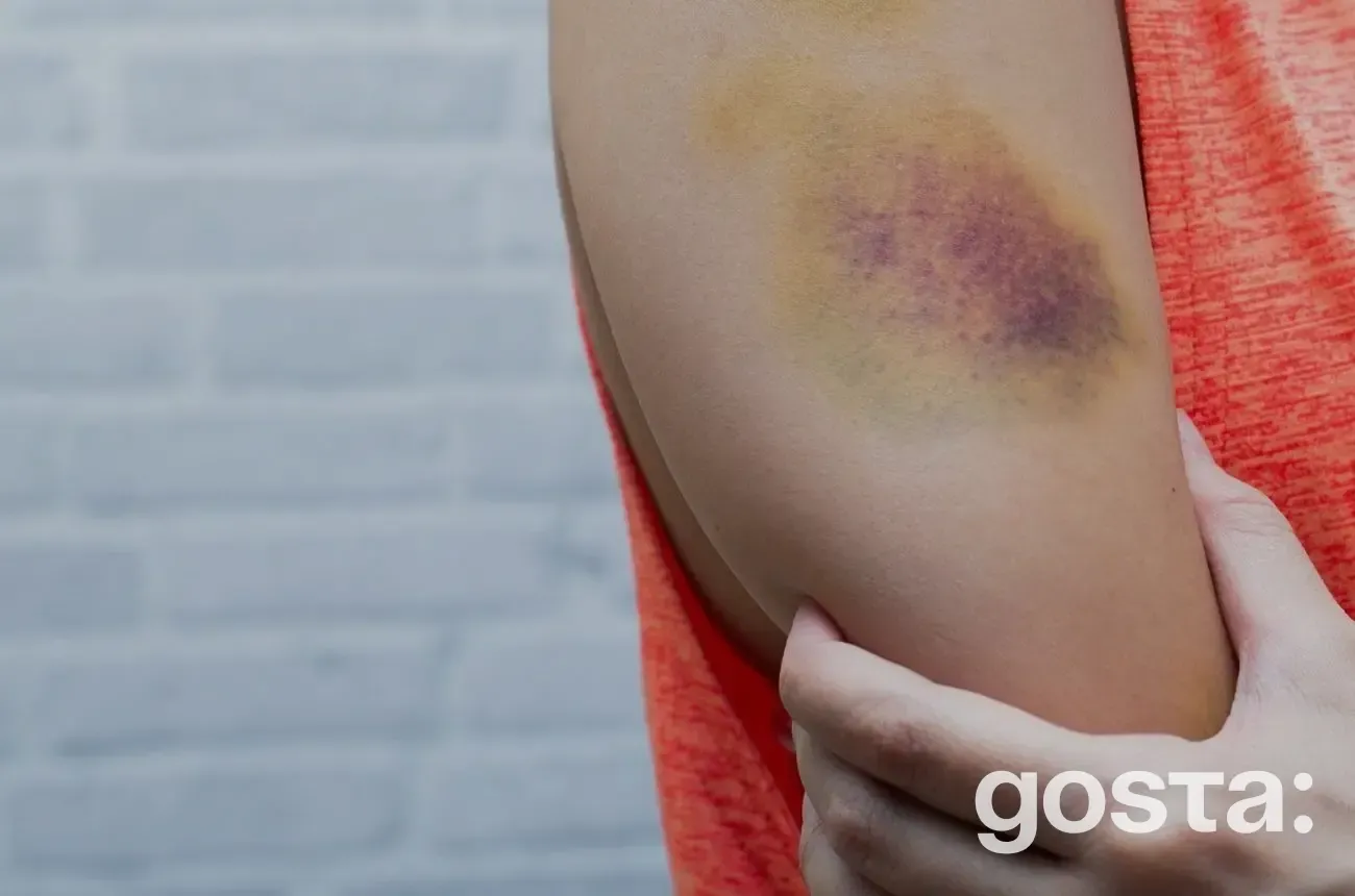 Як краще лікувати гематому?