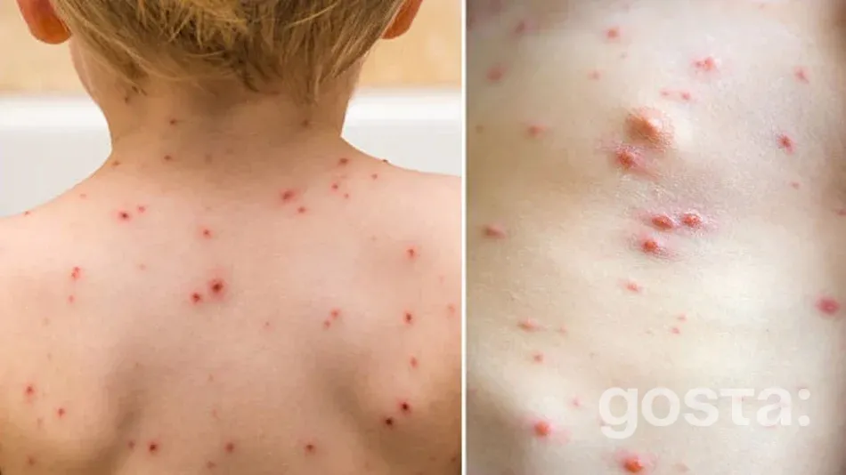 характерний висип при вітряній віспі